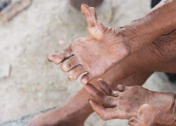 आज विश्व कुष्ठरोग दिवस  विभिन्न कार्यक्रम गरि मनाईदै