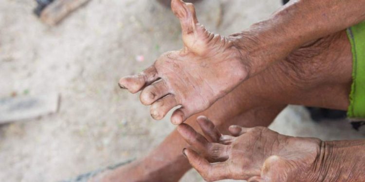 आज विश्व कुष्ठरोग दिवस  विभिन्न कार्यक्रम गरि मनाईदै