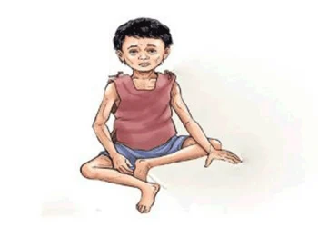 पाकिस्तानमा कुपोषणको शिकार विस लाख बालबालिकामा